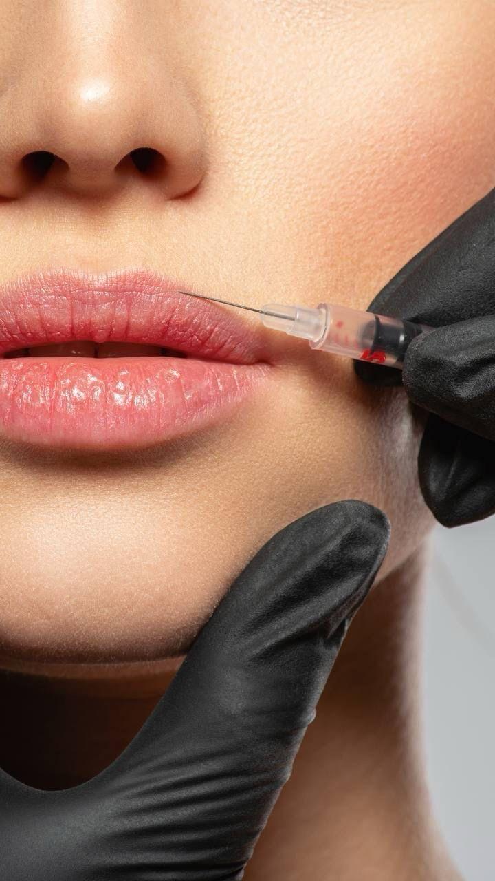 Lippenunterspritzung