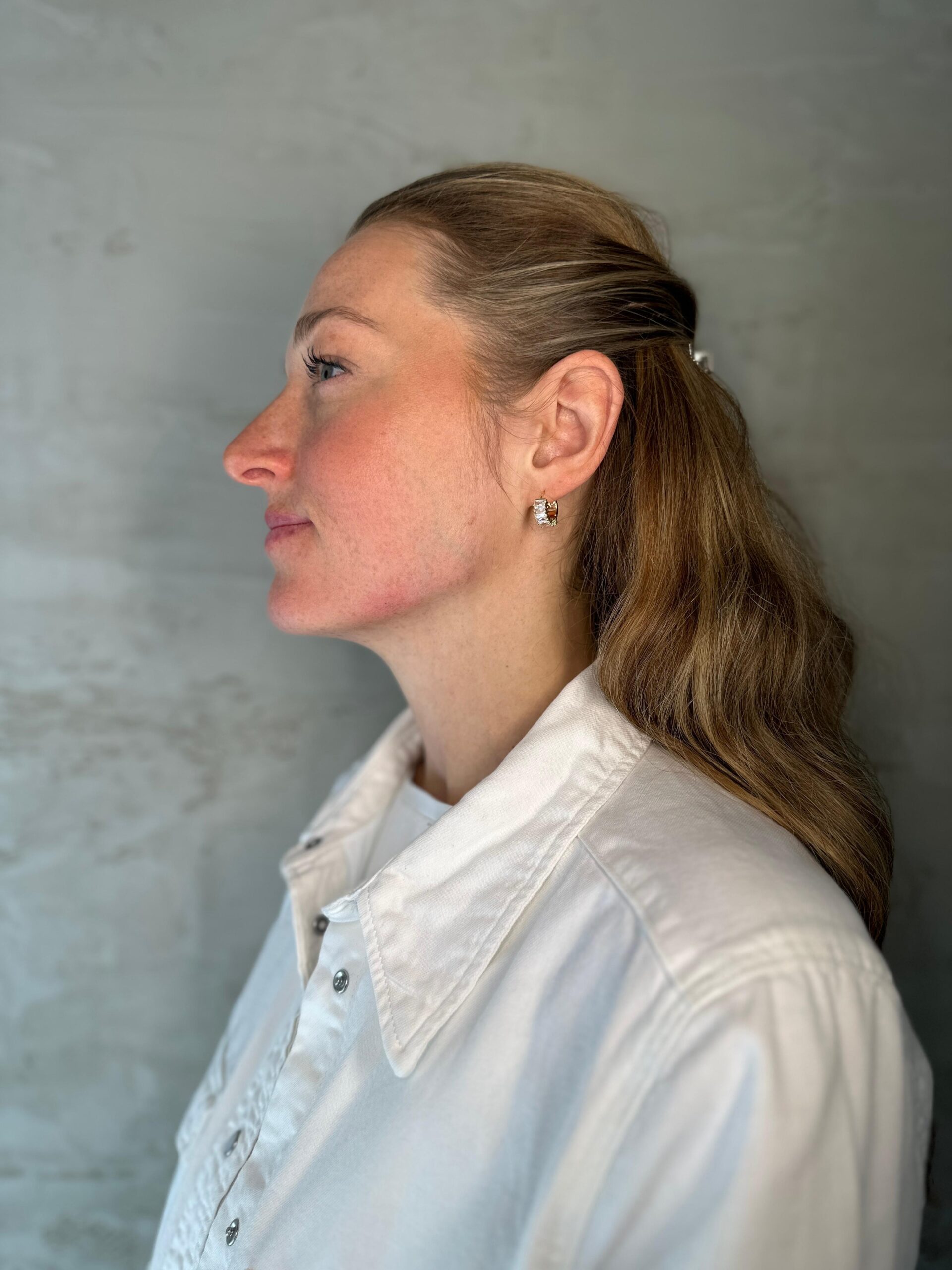 Jawline-Unterspritzung, Venus Ästhetik Naturheilpraxis
